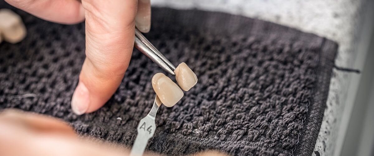 Czy licówki można zdjąć?