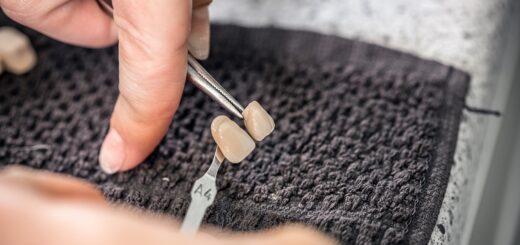 Czy licówki można zdjąć?